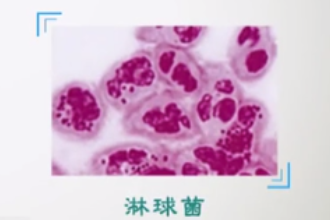 什么是淋病？